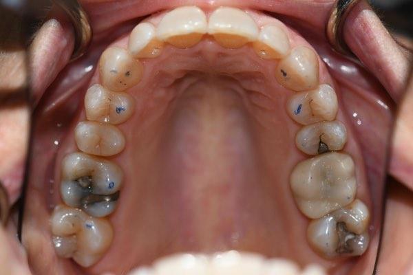 After Invisalign treatment for aligned smile in Glendale AZ