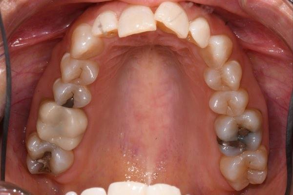 Before Invisalign treatment for aligned smile in Glendale AZ