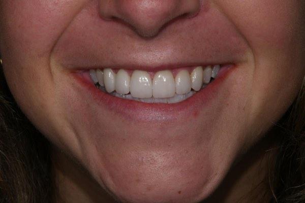 After porcelain veneers treatment at dentist in Glendale AZ