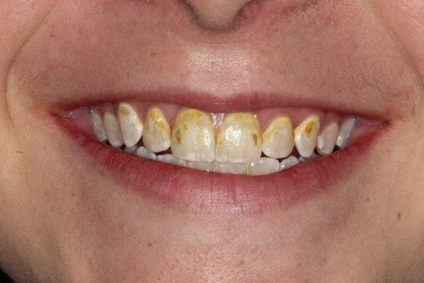 Before porcelain veneers treatment at dentist in Glendale AZ