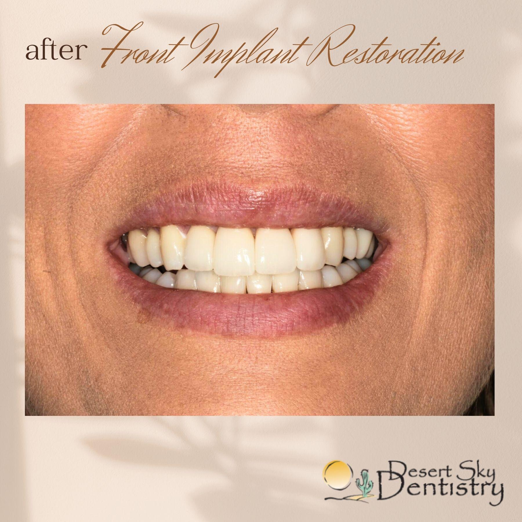 After dental implants restoration for missing teeth at Desert Sky Dentistry Glendale AZ