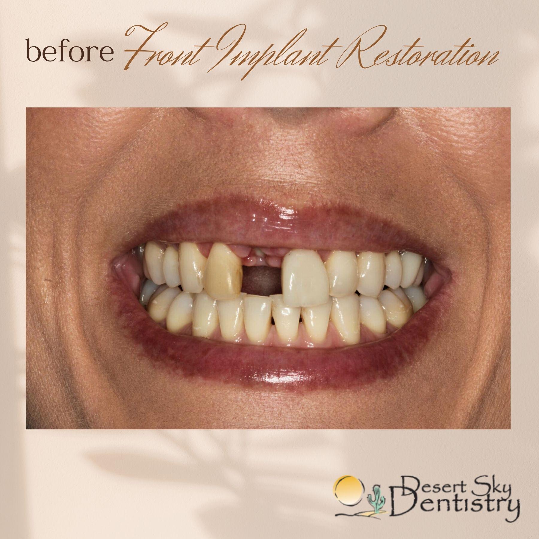 Before dental implants restoration for missing teeth at Desert Sky Dentistry Glendale AZ