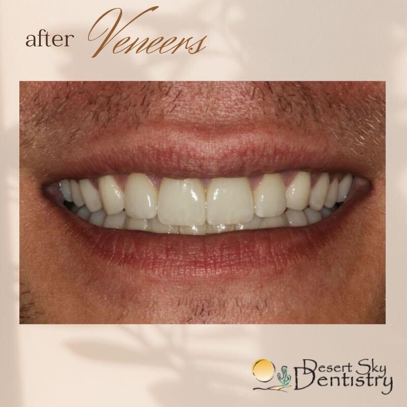 After natural-looking porcelain veneers for smile makeover in Glendale AZ