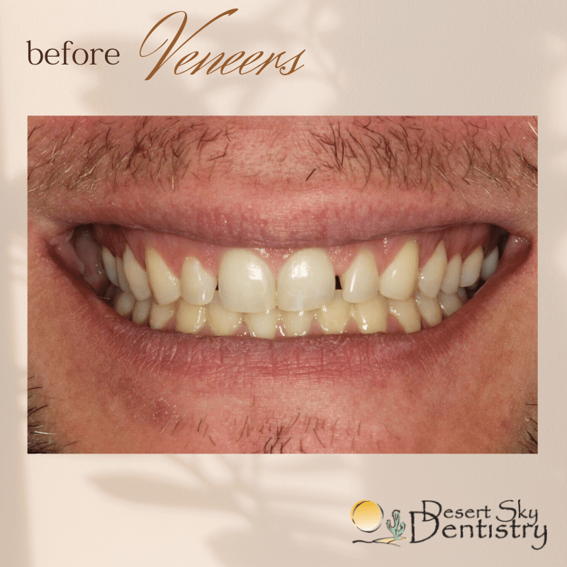 Before natural-looking porcelain veneers for smile makeover in Glendale AZ