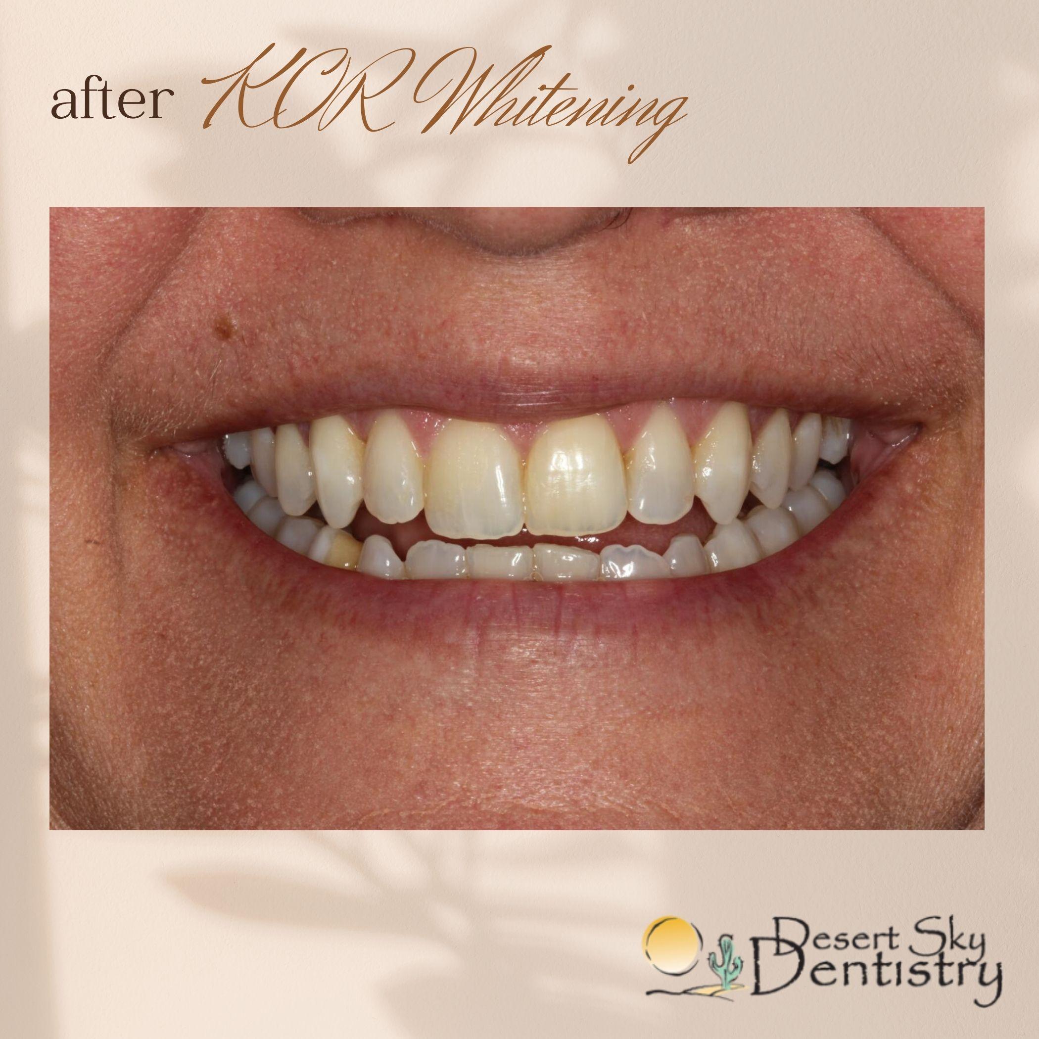 After KöR professional teeth whitening results Glendale AZ
